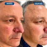 2X1/ FormuClear™ - Elimina verrugas sin dolor y seguro + ENVIO GRATIS