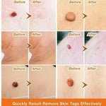 2X1/ FormuClear™ - Elimina verrugas sin dolor y seguro + ENVIO GRATIS